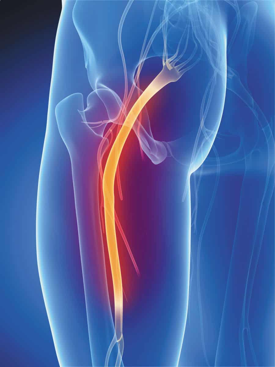 Radicular Pain - Jamestown Spine